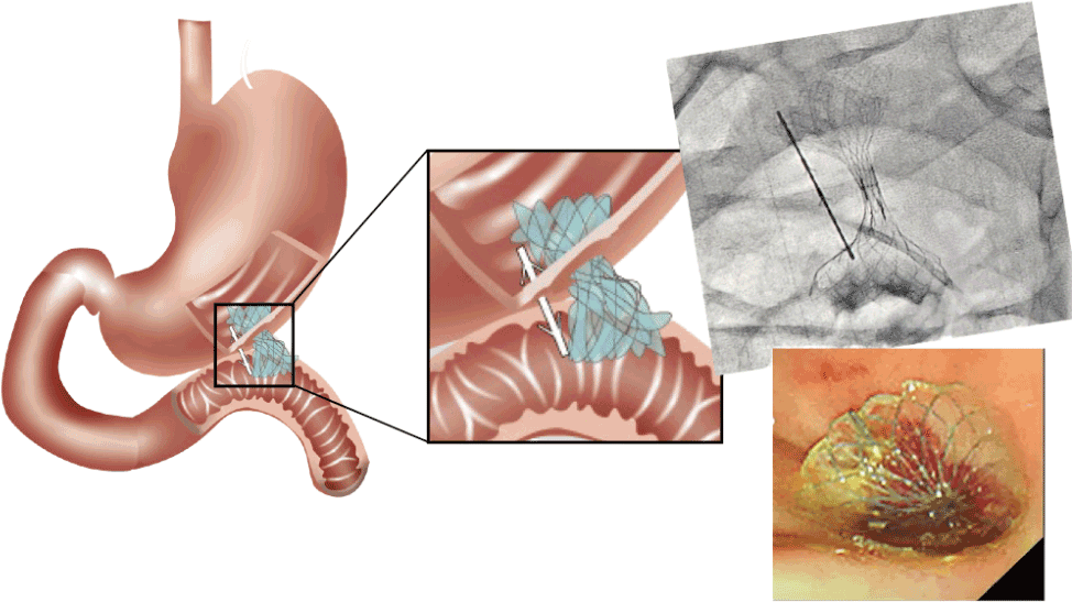 EUS-GJ-STEMS
